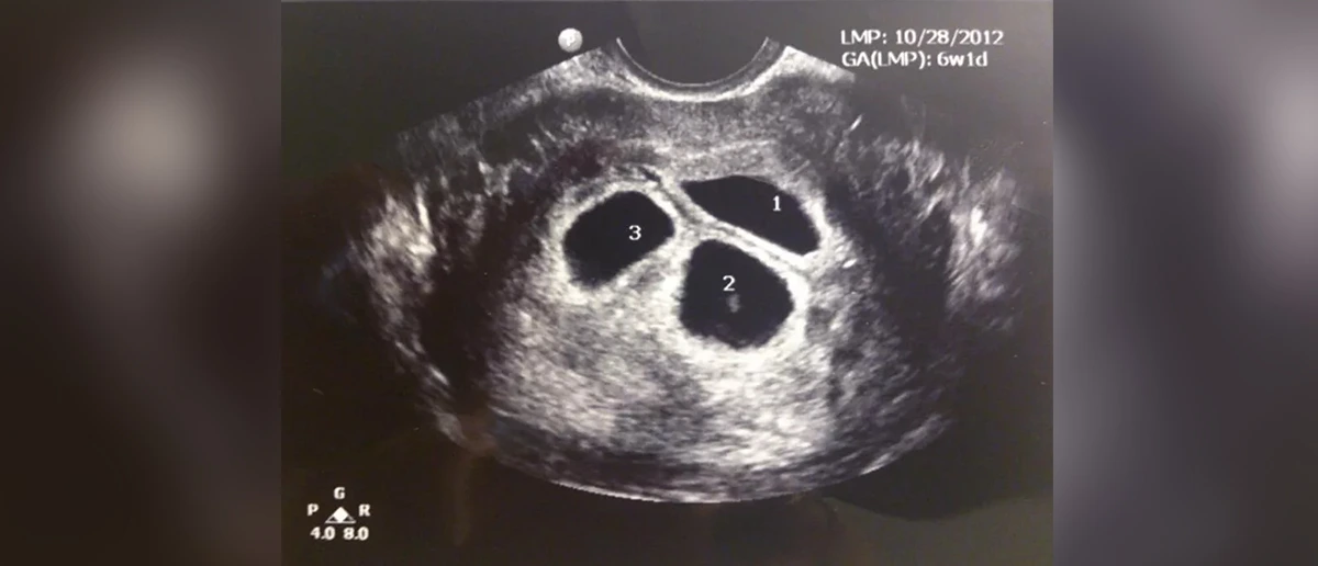 Fetal Redüksiyon Fetal reduksiyon tedavisi kıbrıs